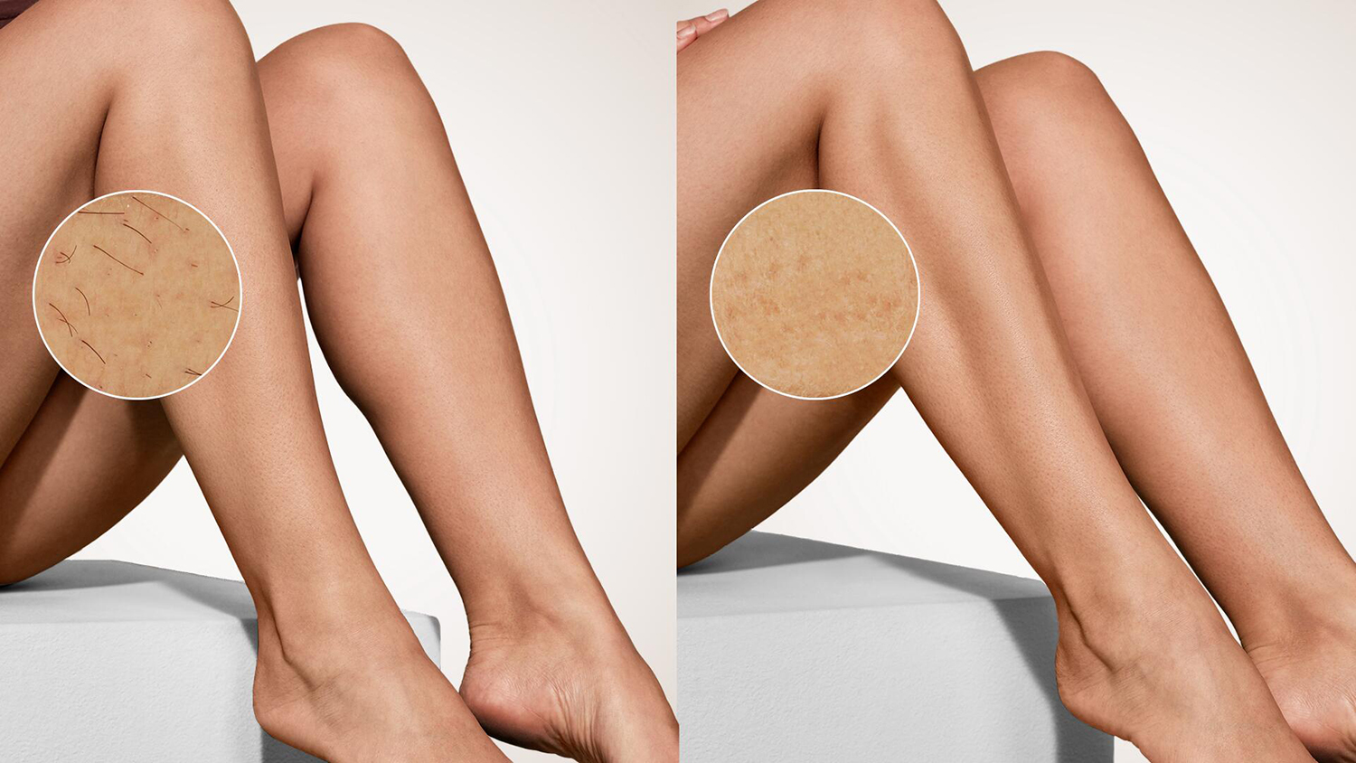 uk&aacute;žka rozdielu pokožky po použ&iacute;van&iacute; IPL epil&aacute;tora Philips Lumea IPL 8000 BRI934/00