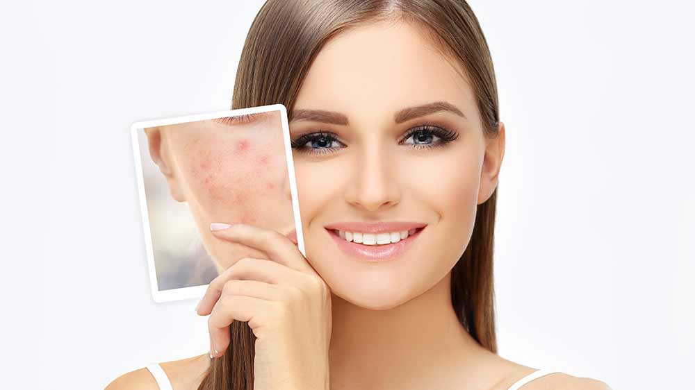 Detail dívčího obličeje s akné a bez akné_04