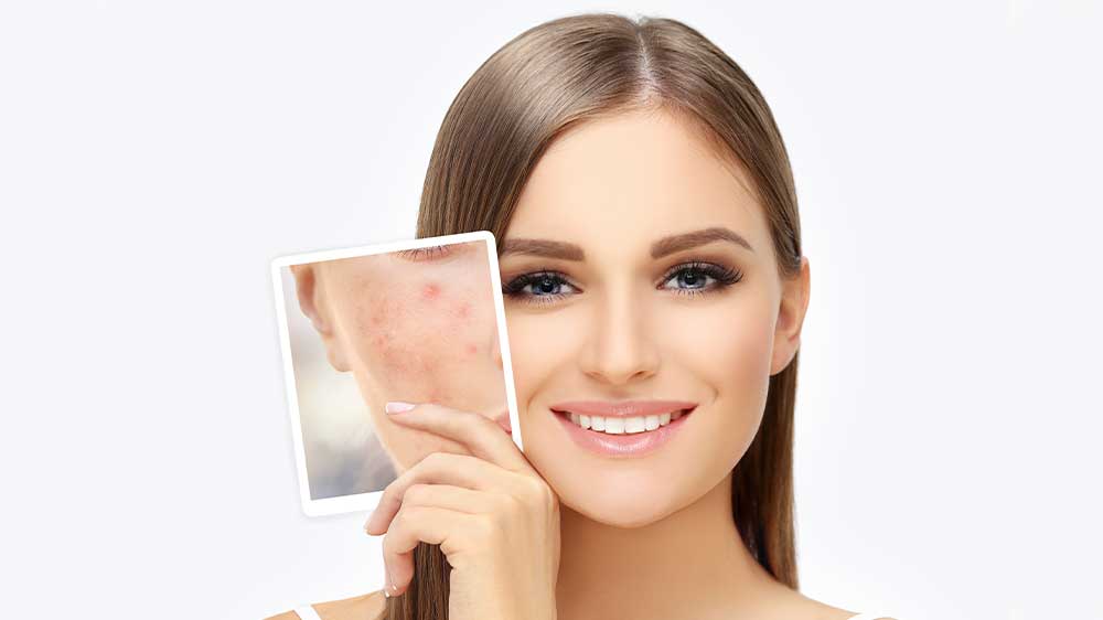 Žena bez akné v obličeji_04